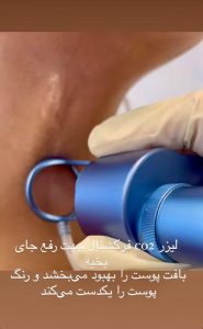لیزر Co2 فرکشنال